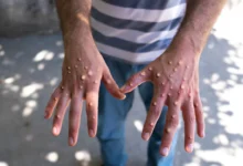 monkeypox cases