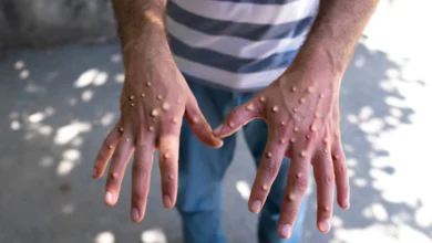 monkeypox cases