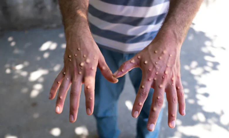 Monkeypox Cases Rising in 2024: Symptoms, Prevention & Latest Updates monkeypox cases